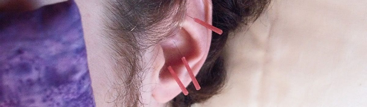 Acupuncture Banner 2-2