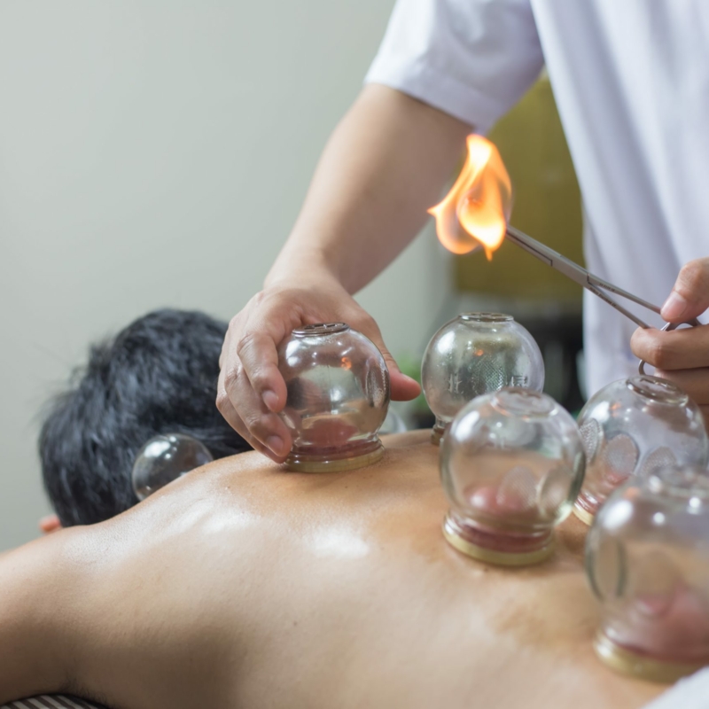 Livonia acupuncturist performing Chinese fire cupping on patient